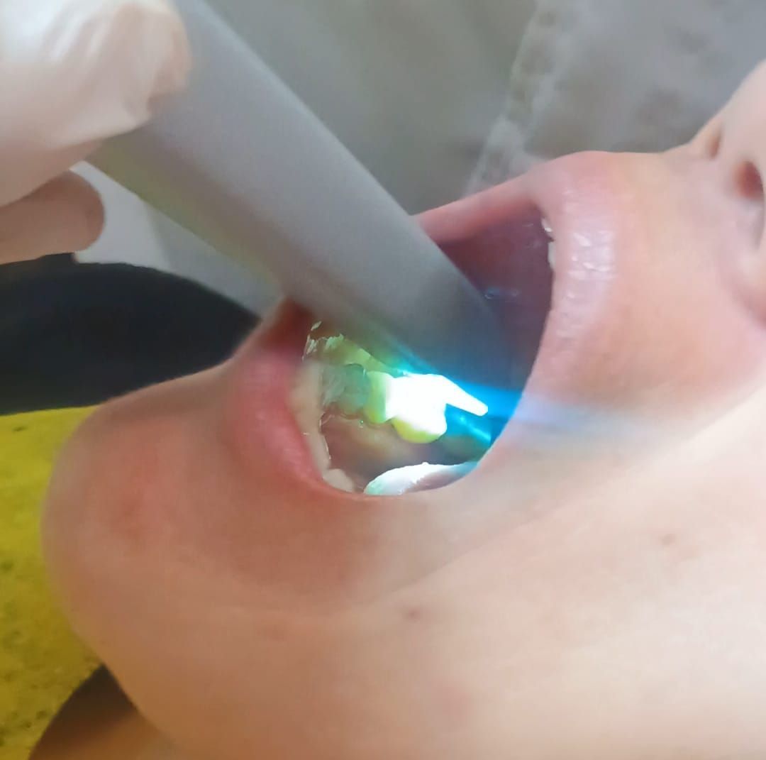 Boca abierta, herramienta dental emite luz azul sobre los dientes; procedimiento dental en curso.