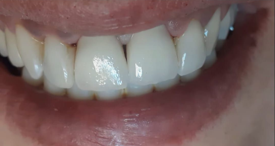 Primer plano de dientes humanos, blancos con acabado brillante, dentro de una boca con labios rosados.