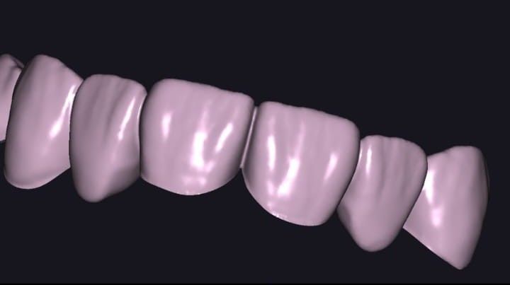 Primer plano de una fila de dientes de color rosa pálido sobre un fondo oscuro, mostrando su forma y alineación.