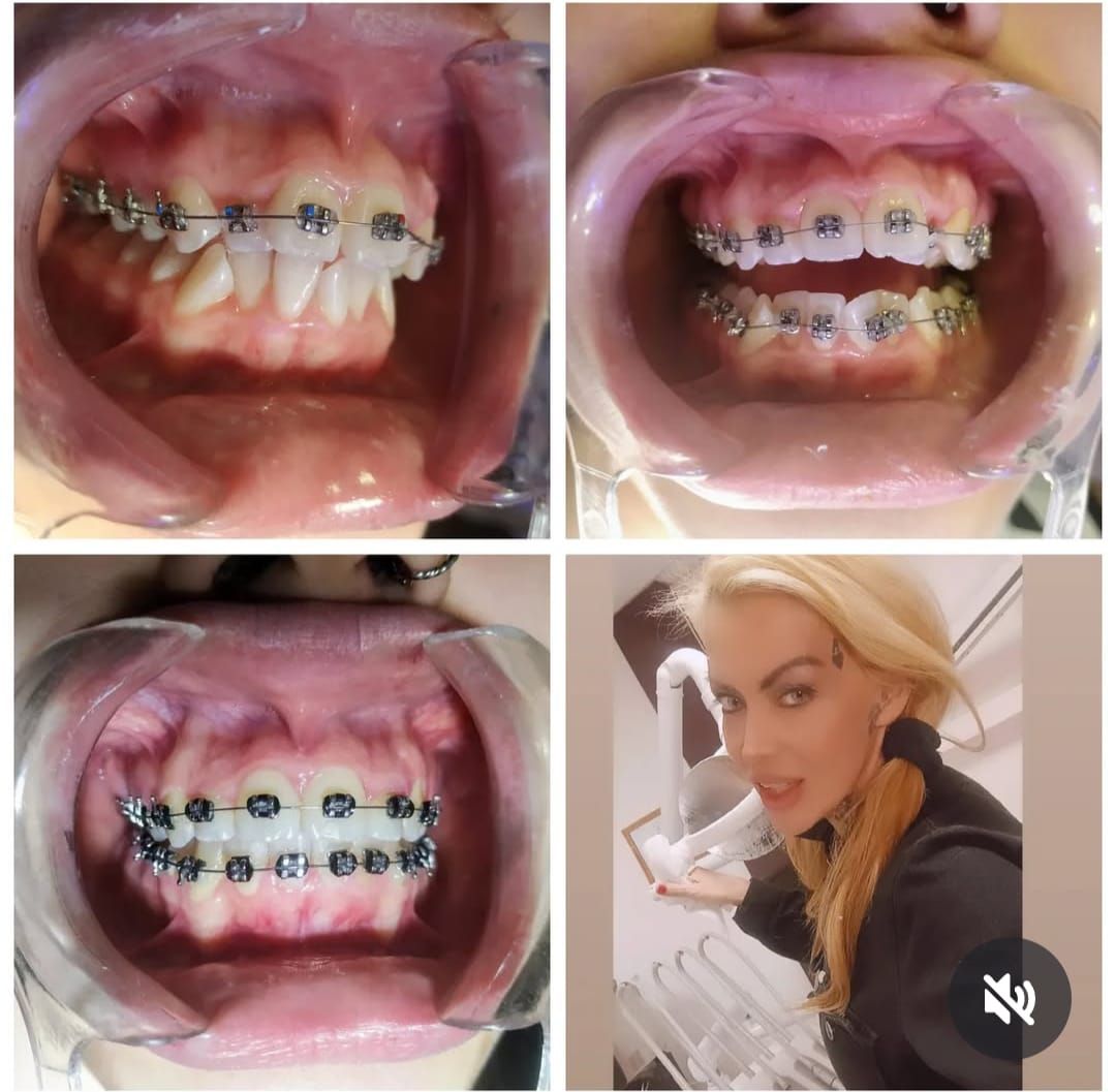 Collage de dientes con aparatos ortopédicos y una mujer en el consultorio del dentista; varias vistas de dientes, 