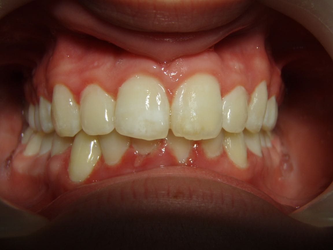 View of damaged & yellow teeth