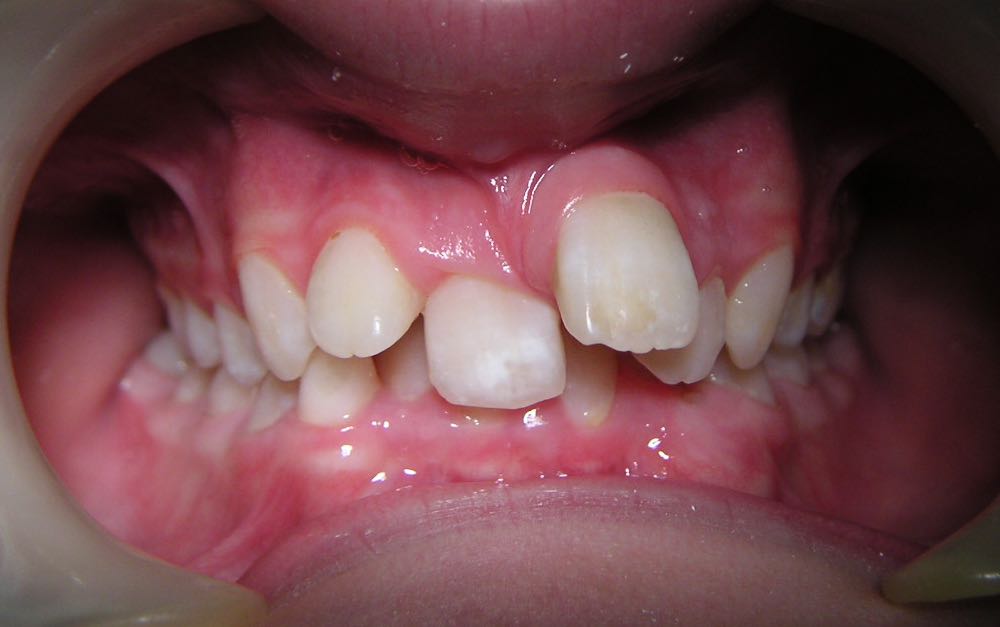 View of un-aligned teeth of customer