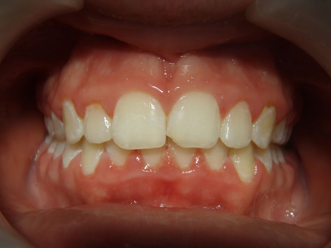 View of a customer teeth after cleaning