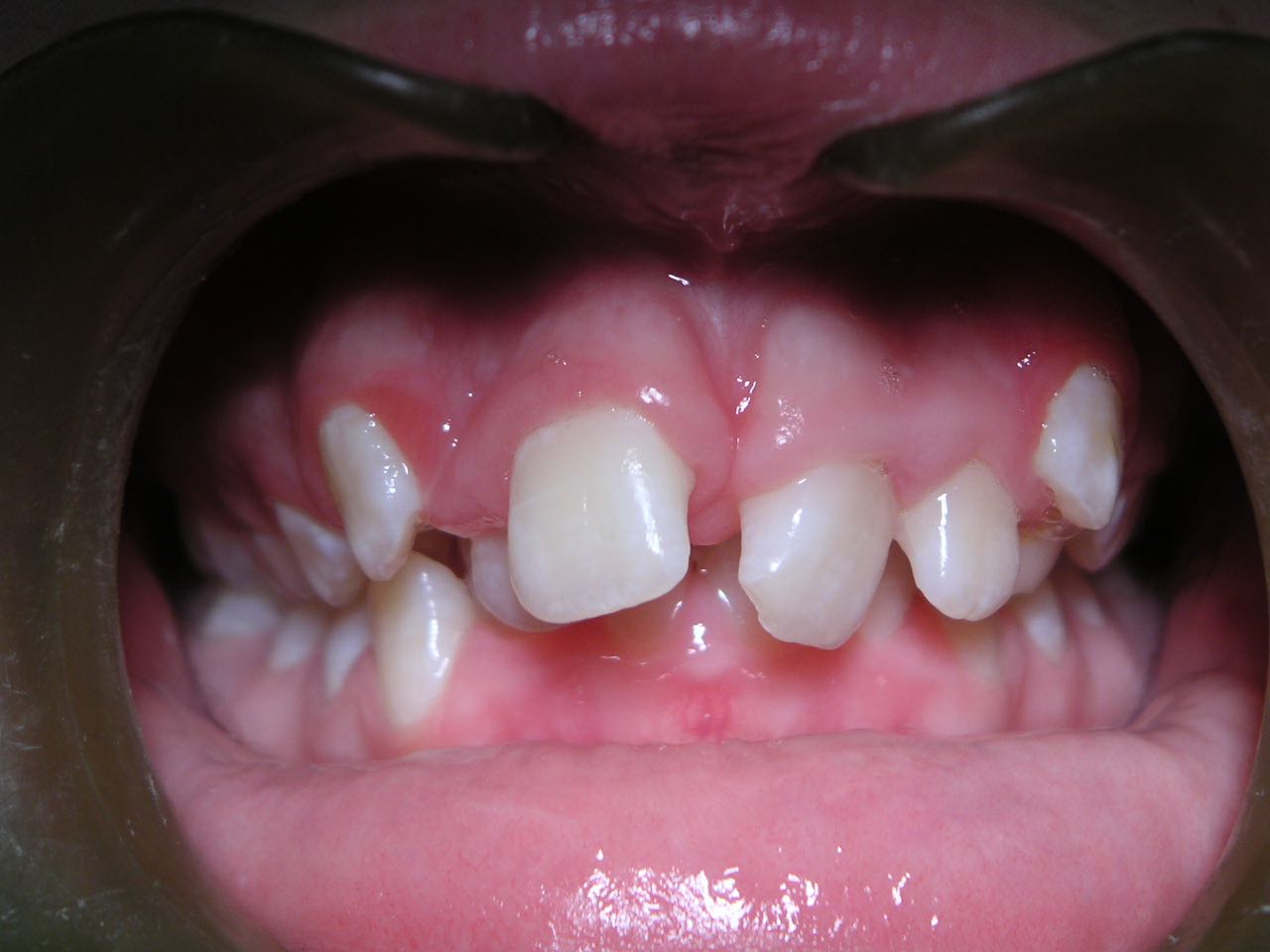 View of un-aligned teeth of customer