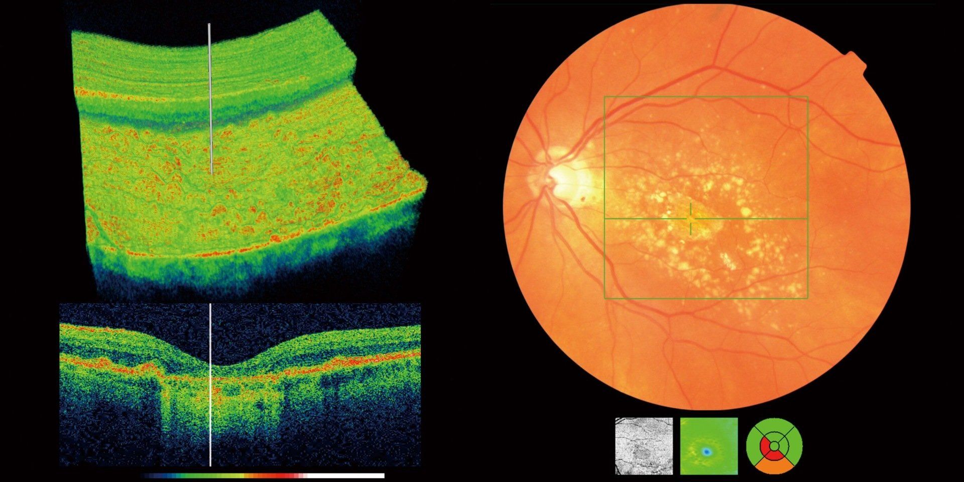 OCT images taken from a 3D OCT. Showing the layers of the retina