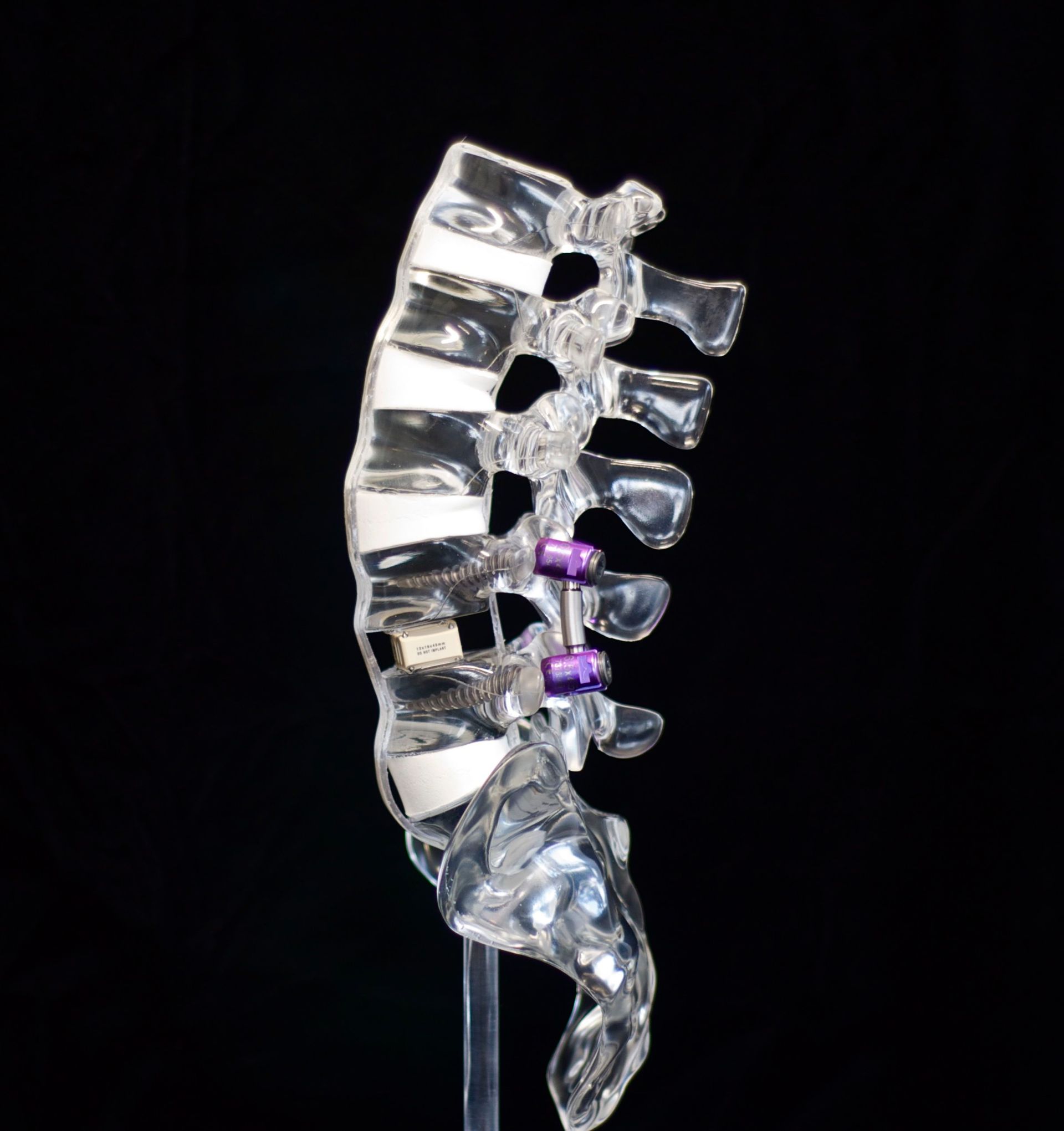 A clear model of a spine with purple screws attached to it.