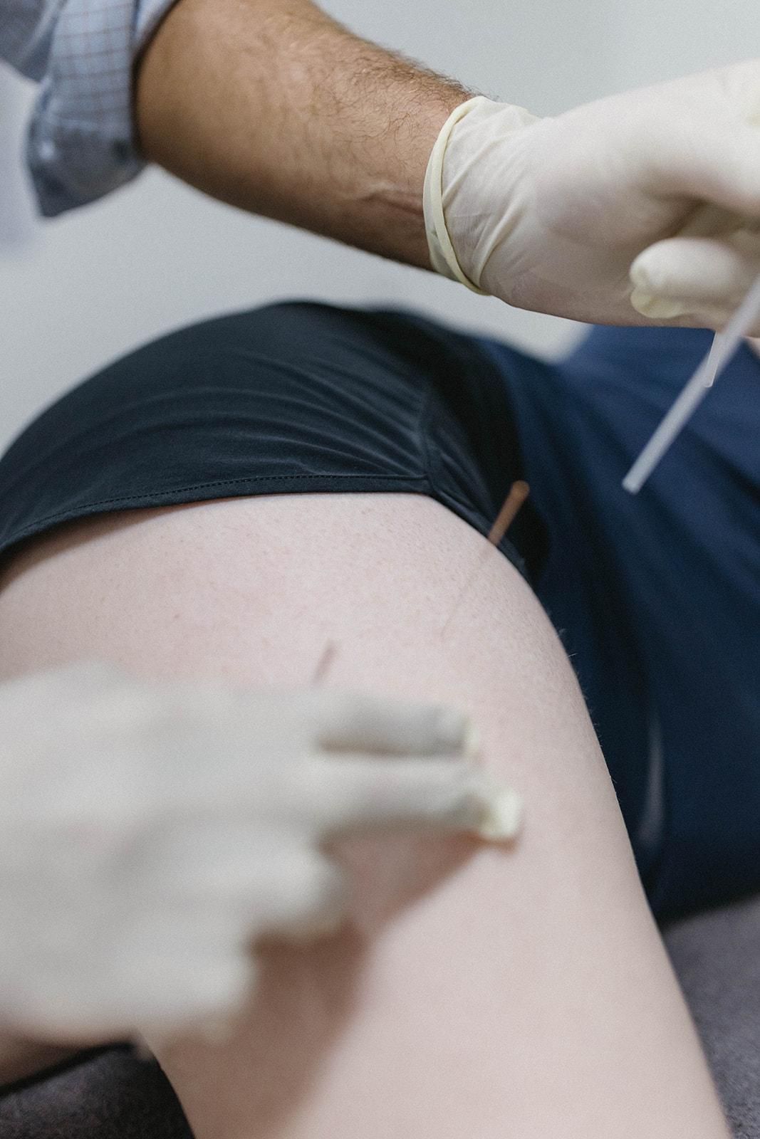 A Person is Getting Acupuncture on Their Leg — Biomedical Sports Podiatry in Forster, NSW