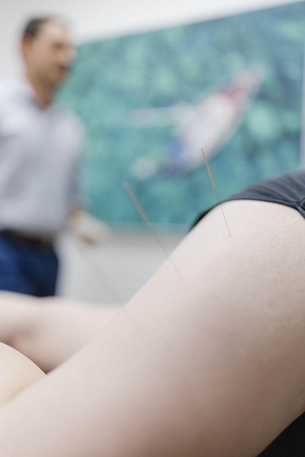 A Woman is Getting an Acupuncture Treatment on Her Leg — Biomedical Sports Podiatry in Taree, NSW