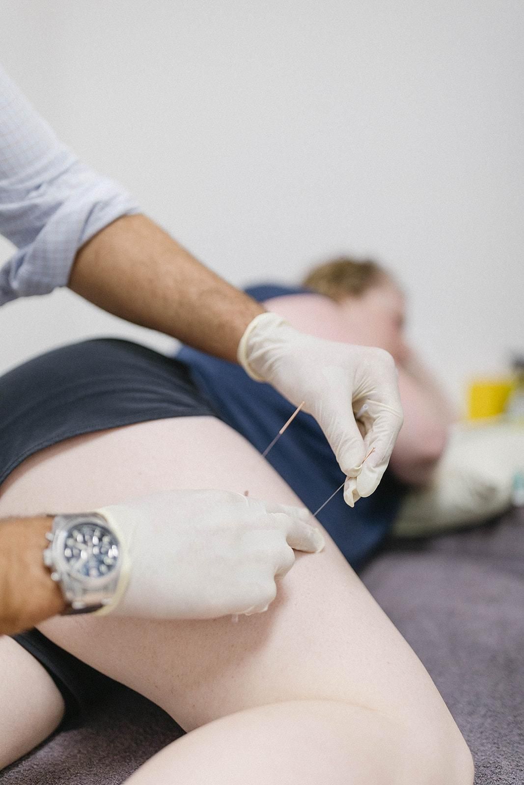 A Person is Getting an Acupuncture Treatment on Their Leg — Biomedical Sports Podiatry in Diamond Beach, NSW