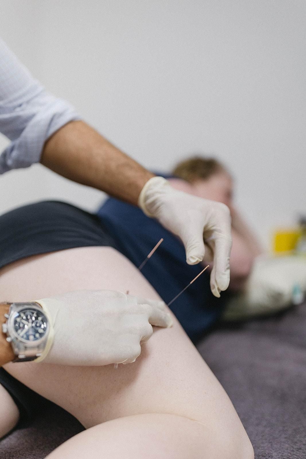 A Person Wearing a Watch is Getting Acupuncture on Their Leg — Biomedical Sports Podiatry in Forster, NSW