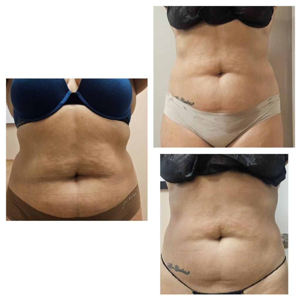 A before and after picture of a woman 's stomach.