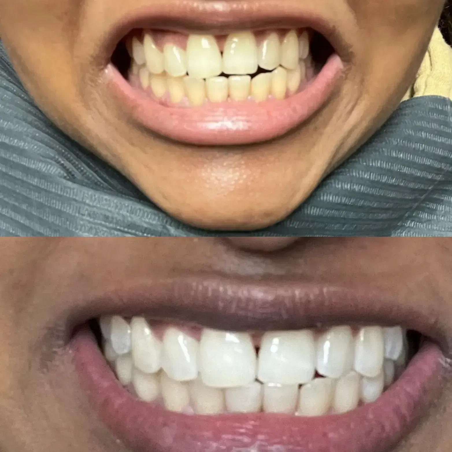 A before and after picture of a woman 's teeth