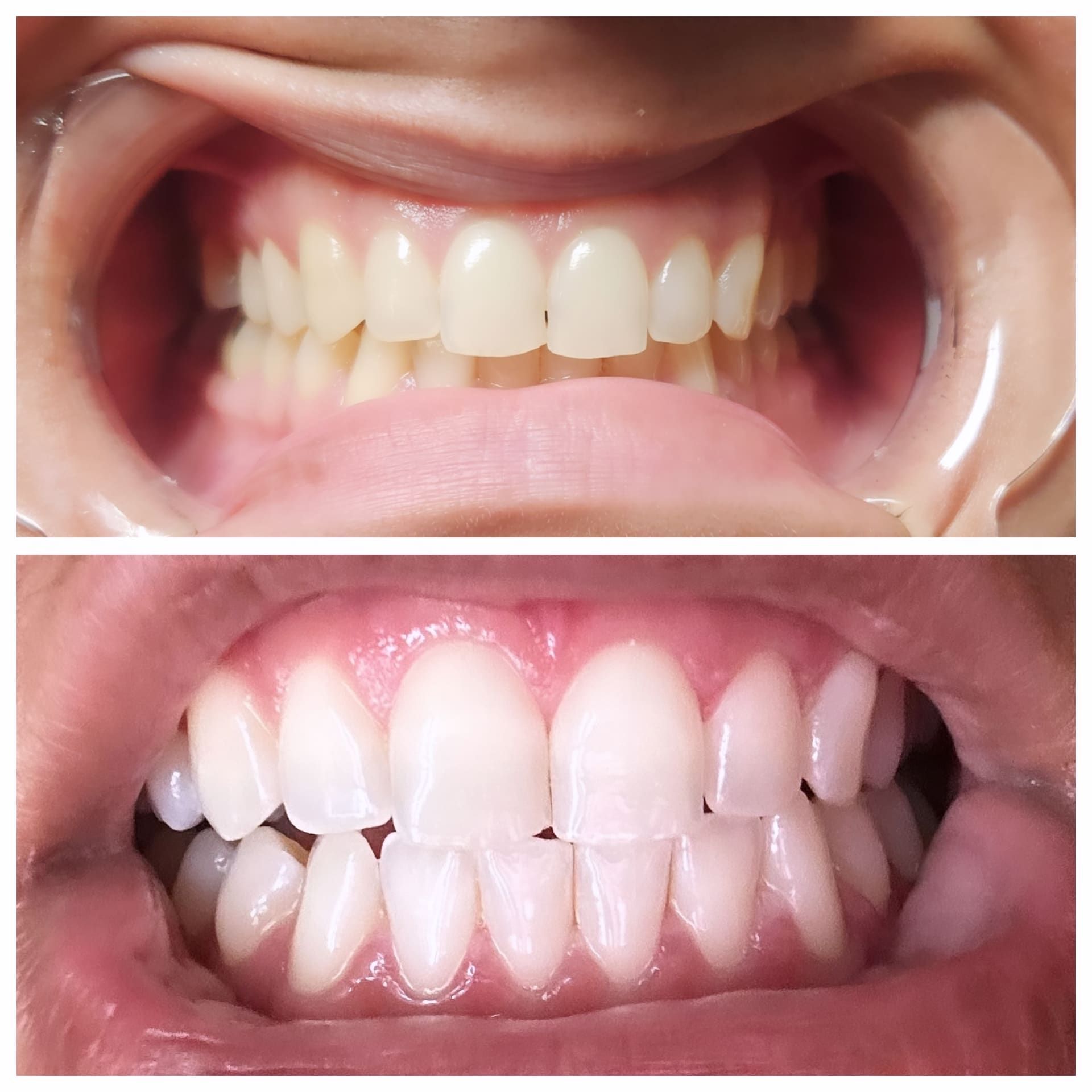 A before and after picture of a person 's teeth.