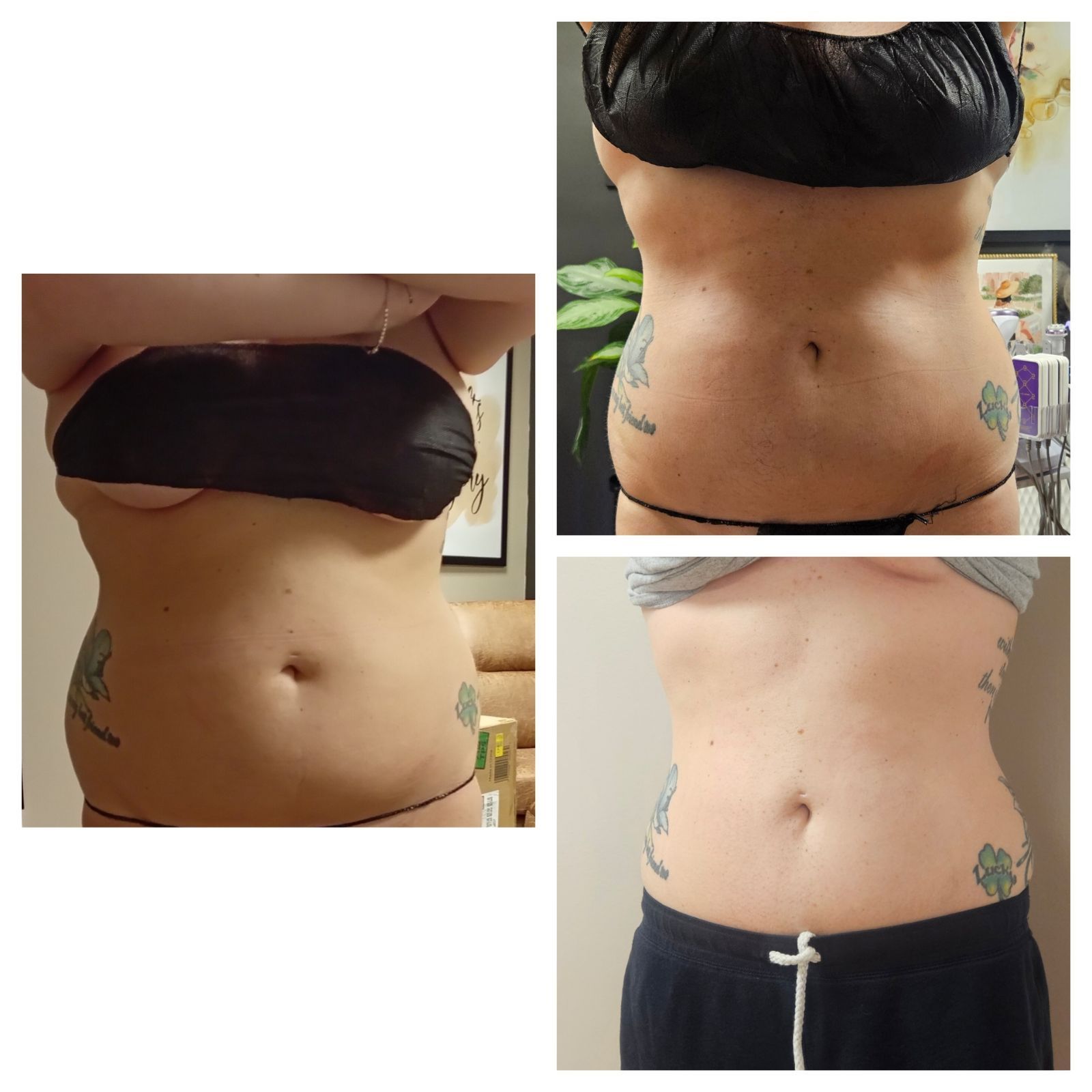 A before and after picture of a woman 's stomach