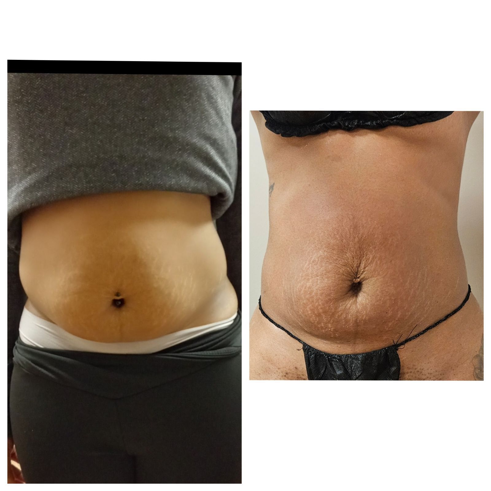 A before and after picture of a woman 's stomach.