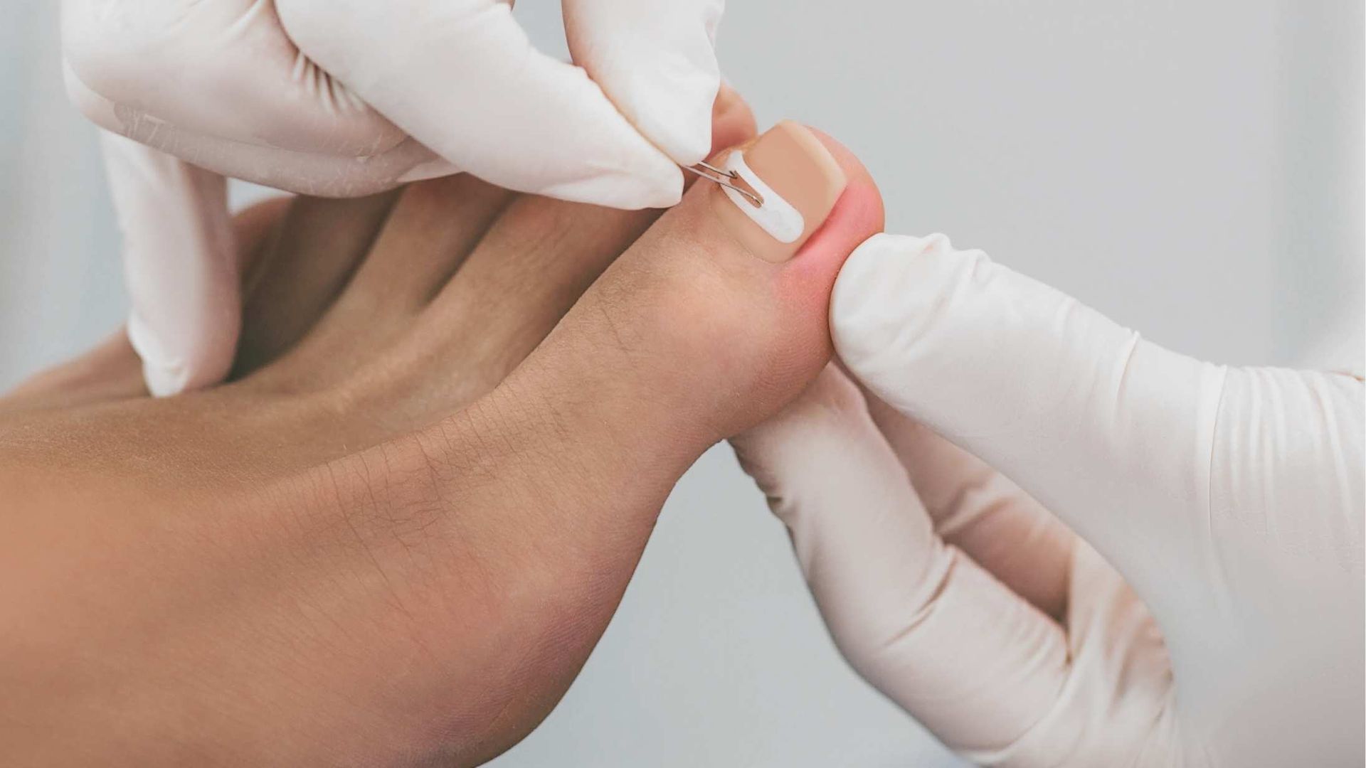 A person is getting their toenails trimmed by a doctor.