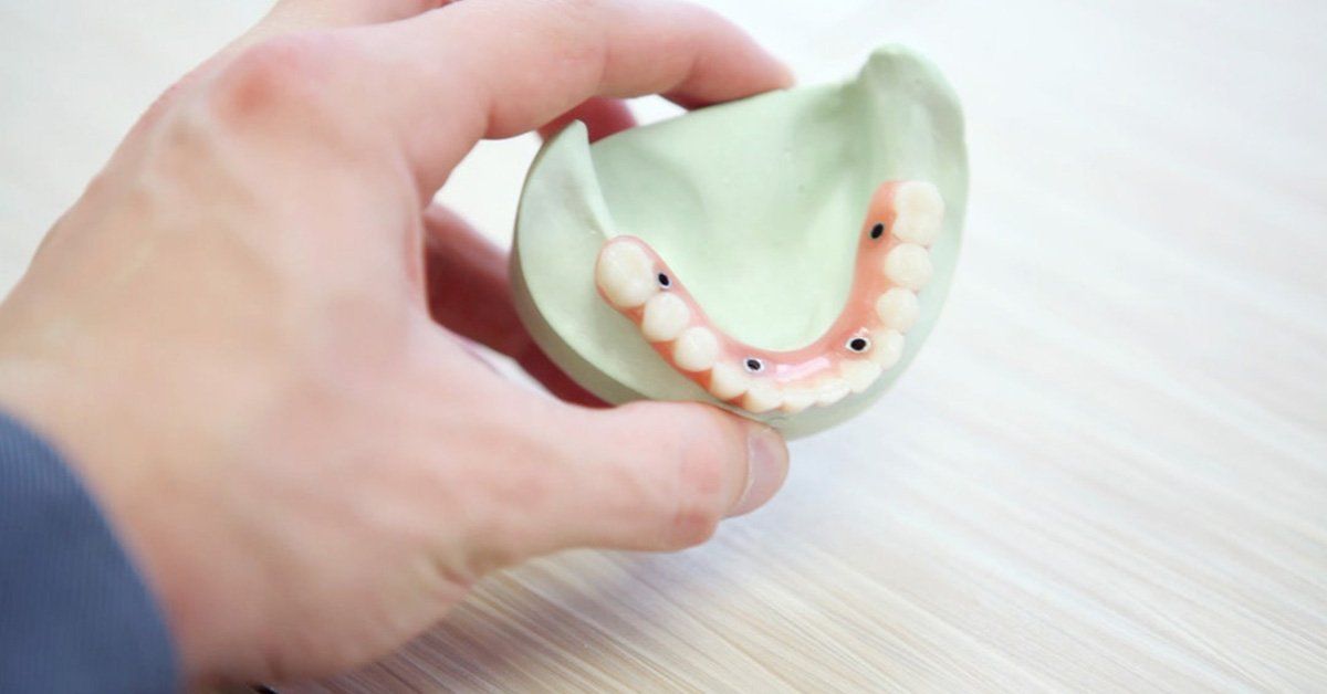 all on 4, all on 4 implants, all on 4 dental implant problems, all on 4 dentures