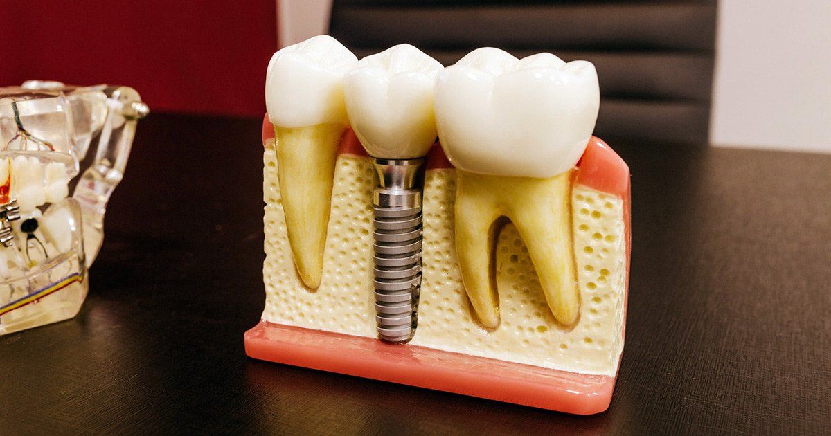 Dental Implants, Dentist Salem NH