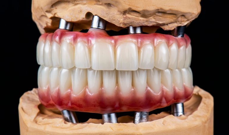 Dentures on a mold, showcasing replacement teeth, gum-colored material, and metal posts against a black background.