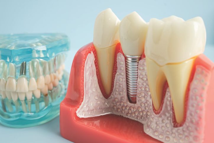 Model of dental implant with a tooth and bone.