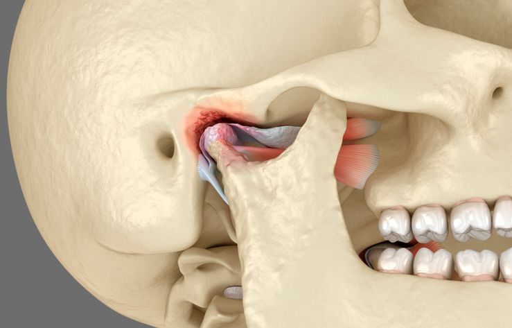 Illustration of a skull showing the temporomandibular joint (TMJ) with inflamed, red-highlighted areas.