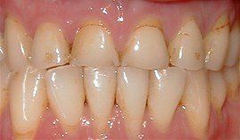 porcelain crowns before