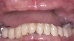 Teeth Before Lower Arch Rehab