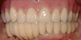 Patients teeth after upper and lower arch rehab