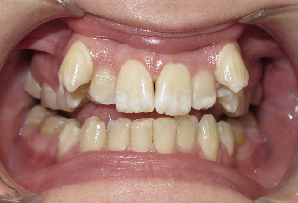 Clinical Treatment Case By Dr. Ziad Omar, City Centre Orthodontics in Mississauga & Bolton