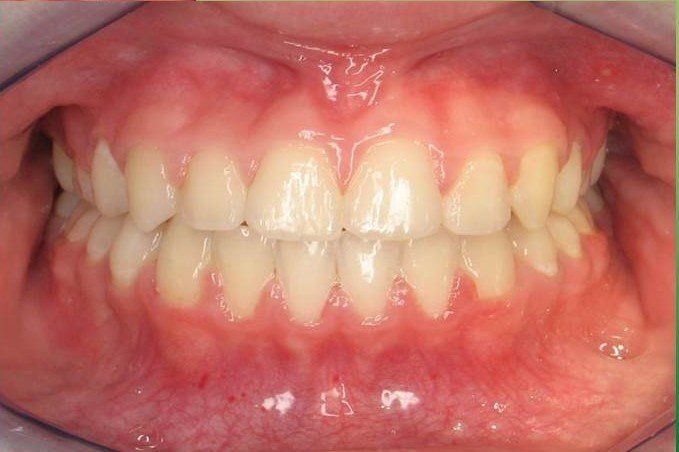 Clinical Treatment Case By Dr. Ziad Omar, City Centre Orthodontics in Mississauga & Bolton