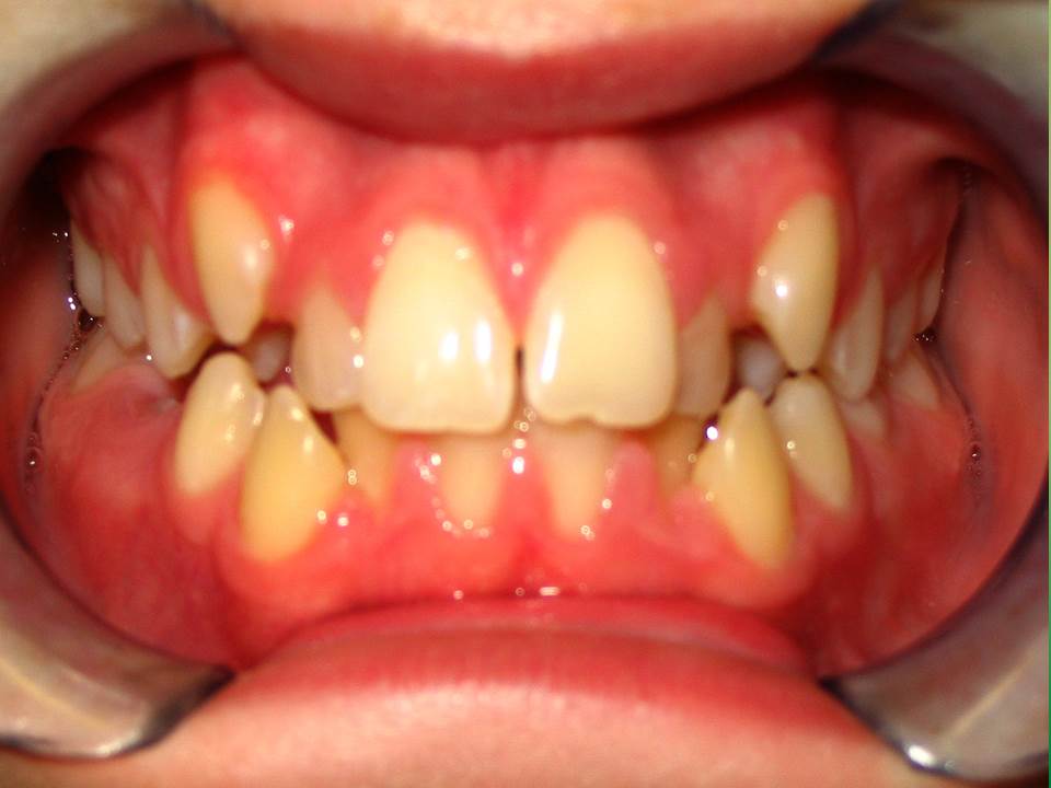 Clinical Treatment Case By Dr. Ziad Omar, City Centre Orthodontics in Mississauga & Bolton
