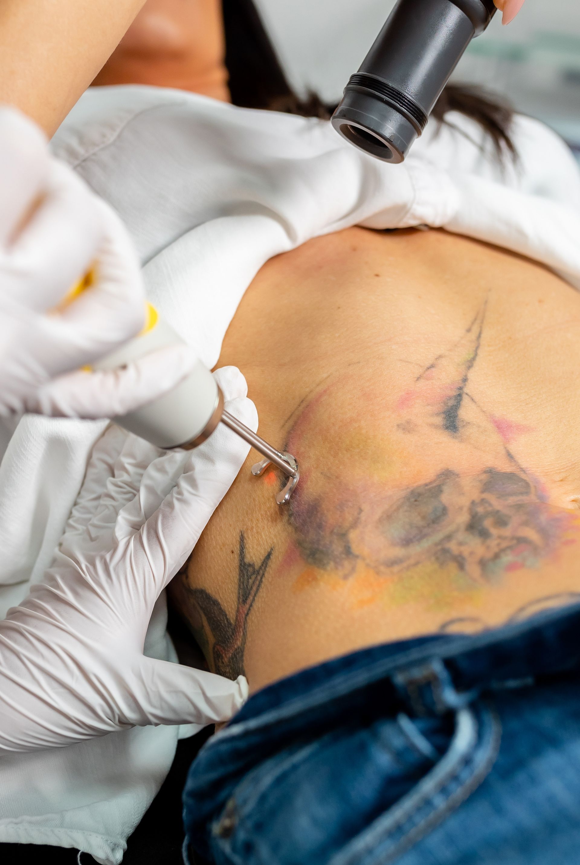 Person undergoing tattoo removal with laser. Doctor in blue gloves holds device over tattoo on shoulder.