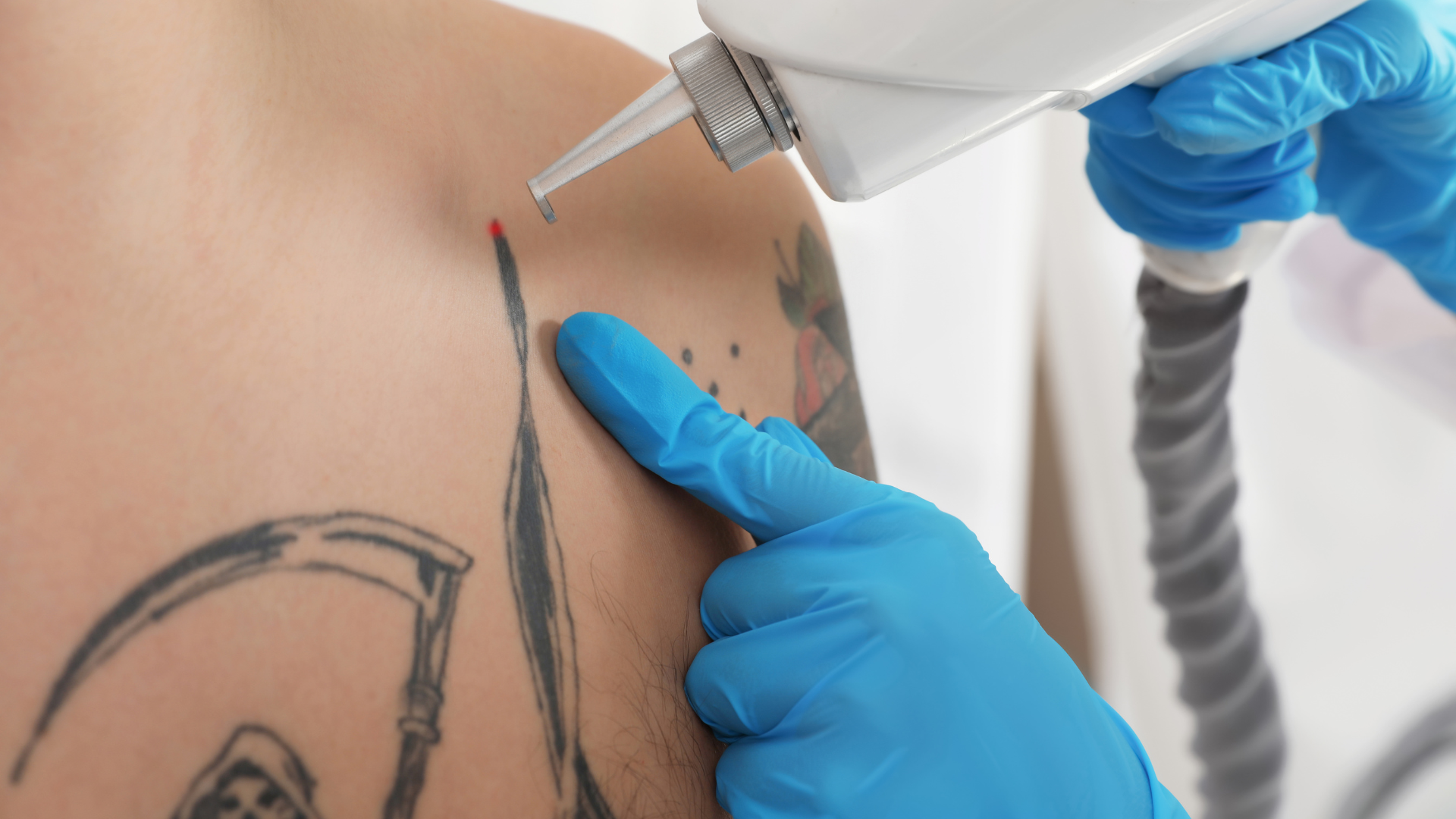 Person undergoing tattoo removal with laser. Doctor in blue gloves holds device over tattoo on shoulder.