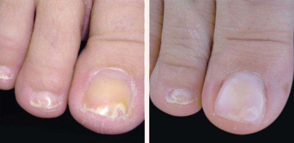 before and after keryflex nail restoration