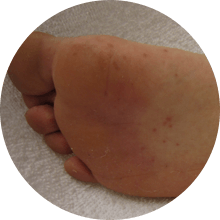 diabetic foot signs