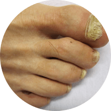 fungal toenails