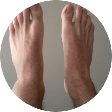 sprained ankle
