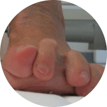 arthritic disorder