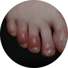 foot injury