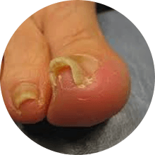 hurting ingrown toenail