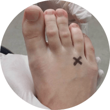 foot ready for surgery
