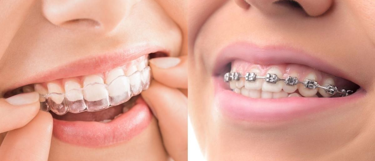 Invisalign vs Braces