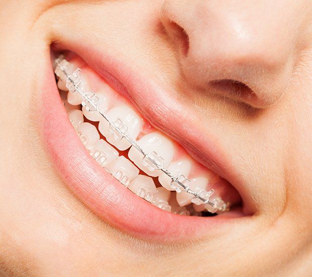 A close up of a woman 's teeth with clear braces.