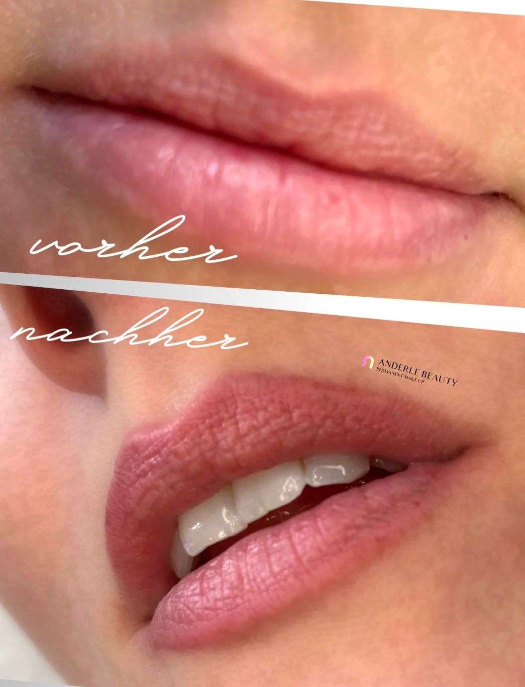 Eine Nahaufnahme der Lippen einer Frau vor und nach einer Behandlung