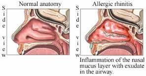 A diagram of a normal anatomy and an allergic rhinitis.