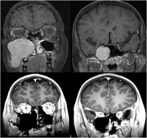 A collage of four mri images of a person 's head showing different stages of a brain tumor.