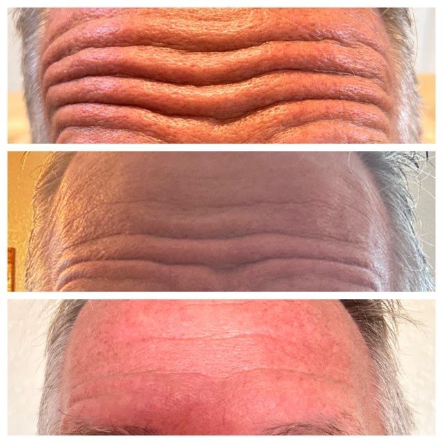 Three pictures of a man 's forehead showing different stages of wrinkles.