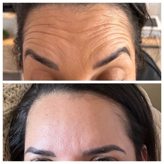 A before and after picture of a woman 's forehead