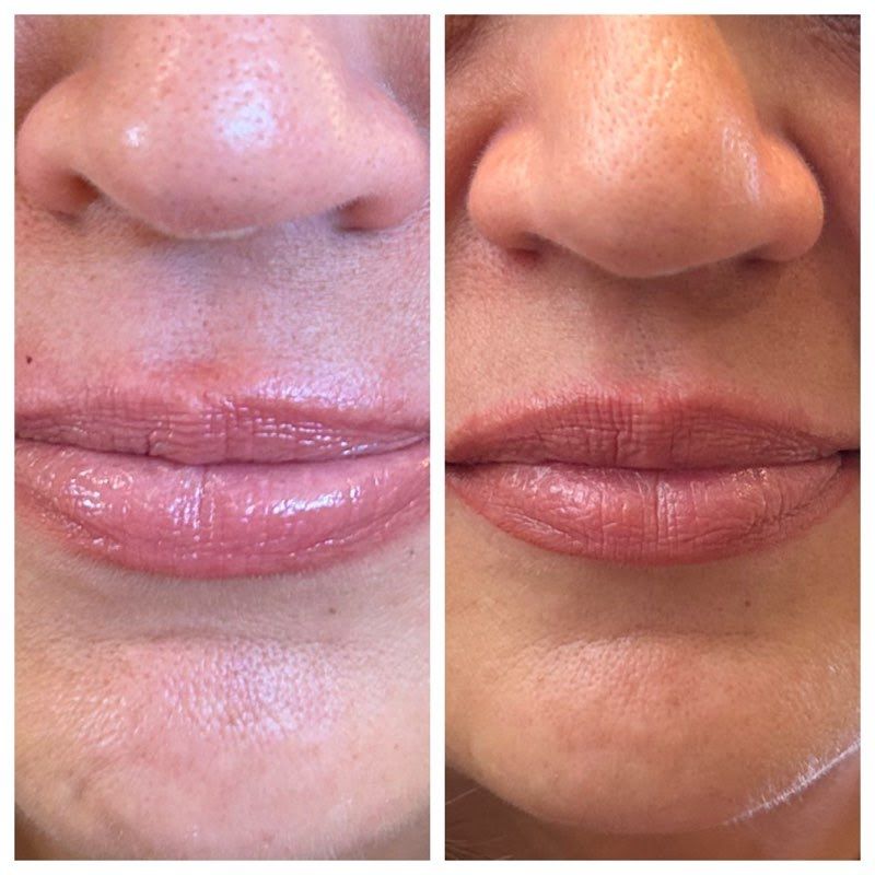 A before and after photo of a woman 's lips.