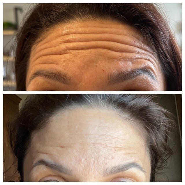 A before and after photo of a woman 's forehead with wrinkles.